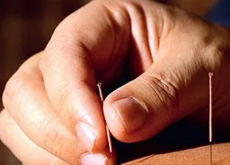 Detalhe da aplicação de agulha de acupuntura