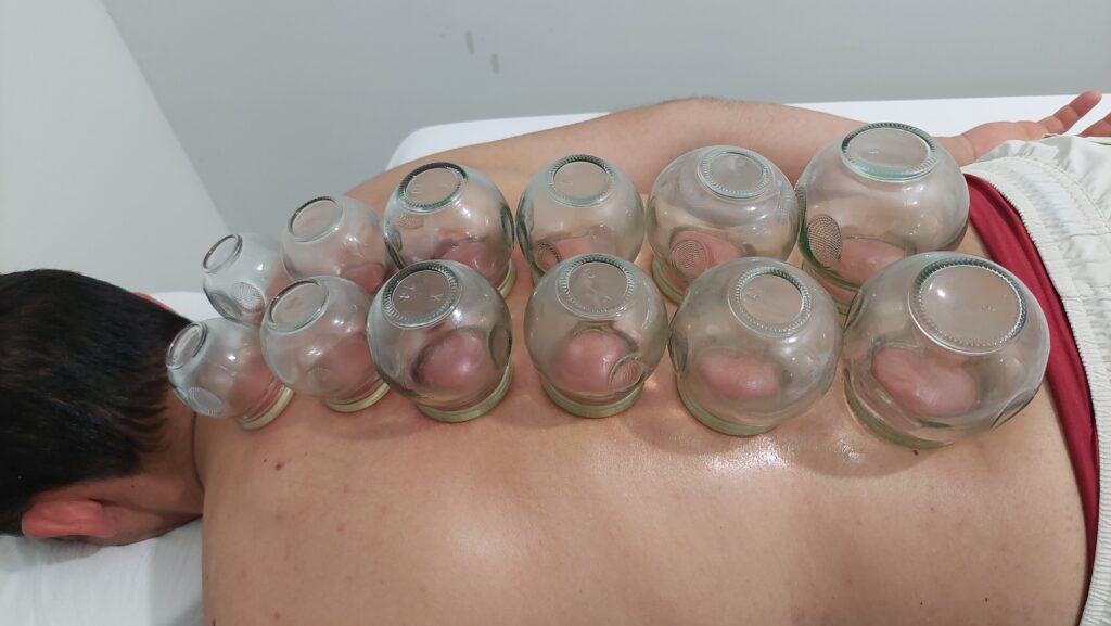 Ventosaterapia